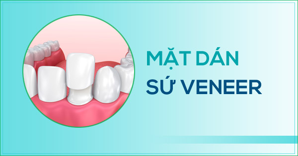 MẶT DÁN SỨ VENEER - Nha khoa Diamond Biên Hòa