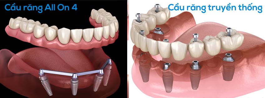 Cầu răng All On 4 và Cầu răng truyền thống.