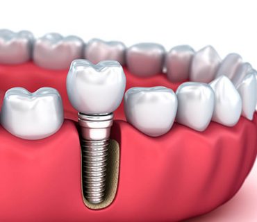 Trồng răng implant có đau không?