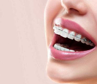 Chi phí của các loại niềng răng trên thị trường