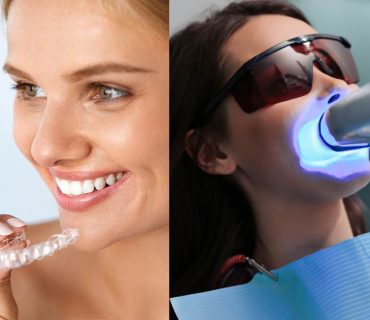 Khác biệt giữa tẩy trắng răng bằng laser với máng tẩy trắng răng chuyên nghiệp