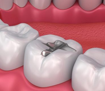 Trám răng là gì? Trám răng mất thời gian bao lâu?