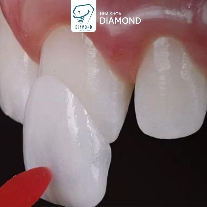 Dịch vụ dán sứ Veneer tại Nha khoa Diamond Biên Hòa