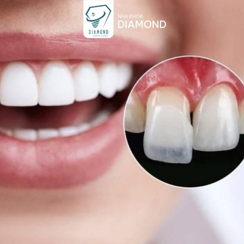 Dịch vụ dán sứ Veneer tại Nha khoa Diamond Biên Hòa