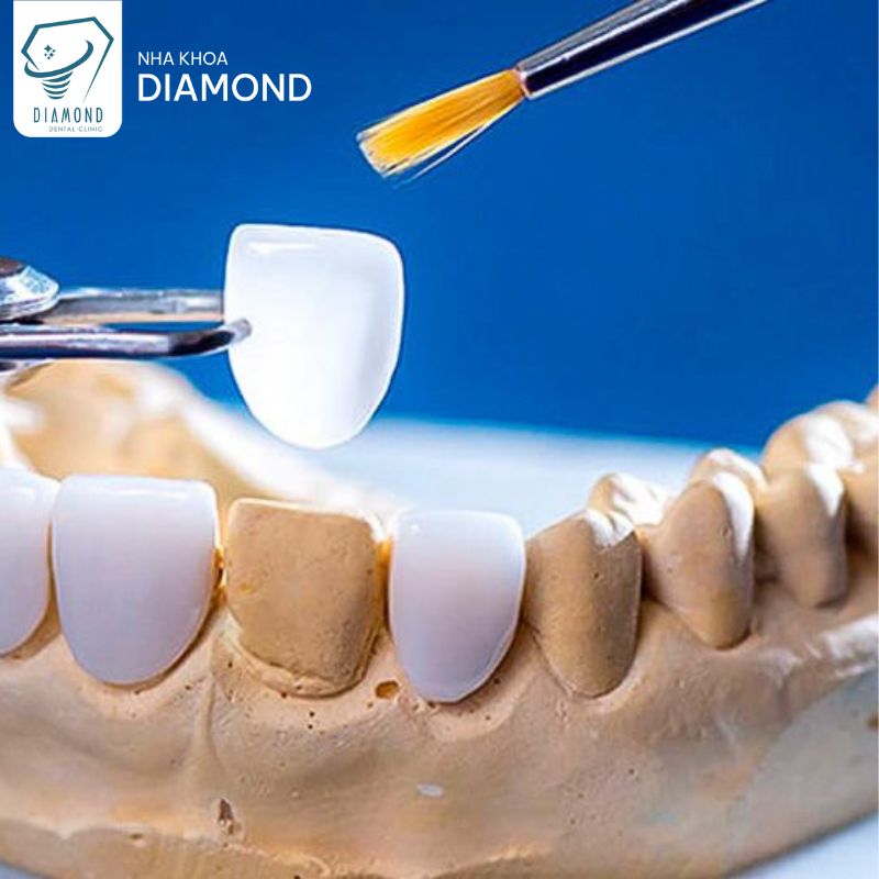 Dịch vụ dán sứ Veneer tại Nha khoa Diamond Biên Hòa