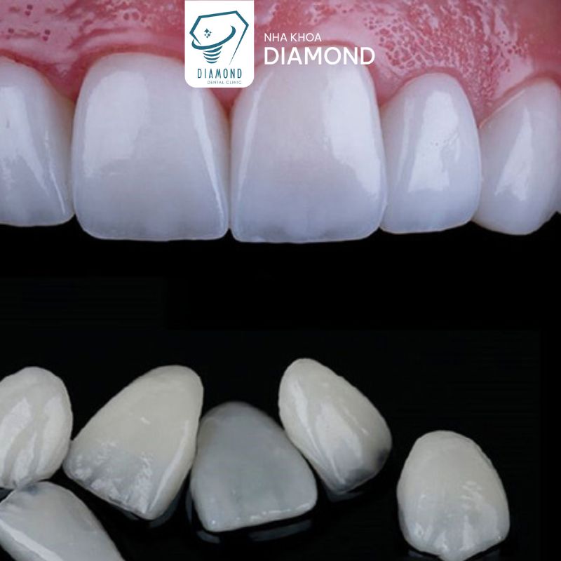 Dịch vụ dán sứ Veneer tại Nha khoa Diamond Biên Hòa