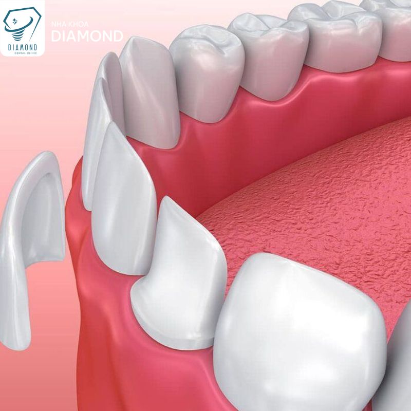 Dịch vụ dán sứ Veneer tại Nha khoa Diamond Biên Hòa