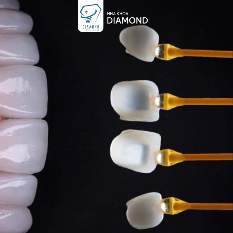 Dịch vụ dán sứ Veneer tại Nha khoa Diamond Biên Hòa