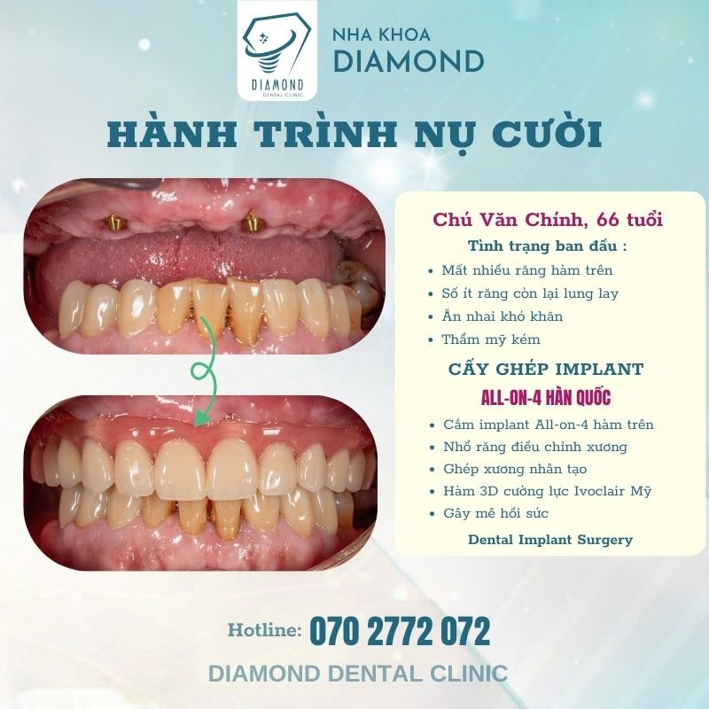 Dịch vụ cấy ghép Implant tại Nha khoa Diamond Biên Hòa