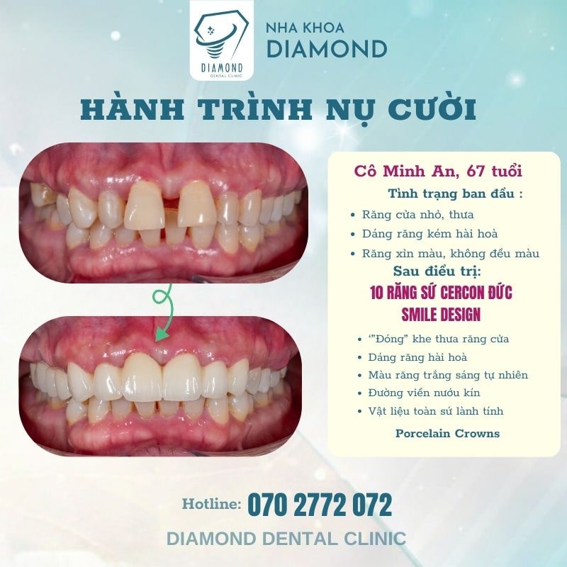 Dịch vụ Trồng răng sứ tại Nha khoa Diamond Biên Hòa