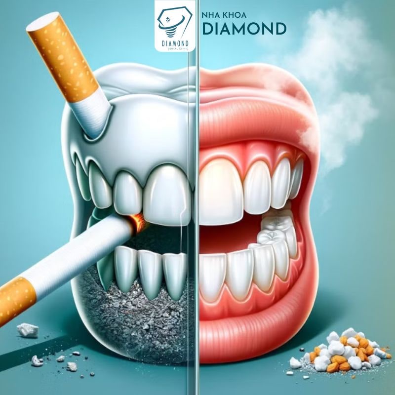 Hút Thuốc Có Thể Gây Tổn Thương Nghiêm Trọng Cho Răng Miệng