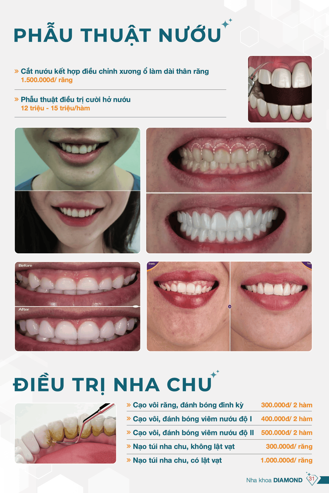 Bảng giá cắt nướu nha khoa Diamond 