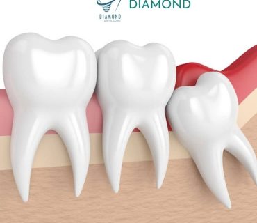 Giải quyết nỗi lo răng khôn tại Nha khoa Diamond Biên Hòa