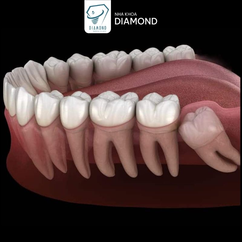 Dịch vụ nhổ răng khôn tại Nha khoa Diamond