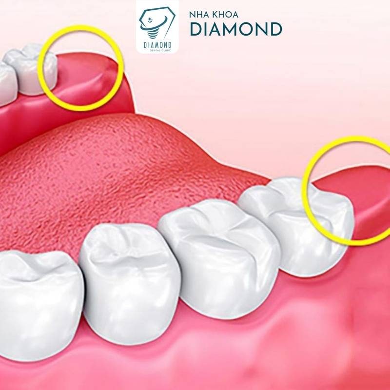 Dịch vụ nhổ răng khôn tại Nha khoa Diamond