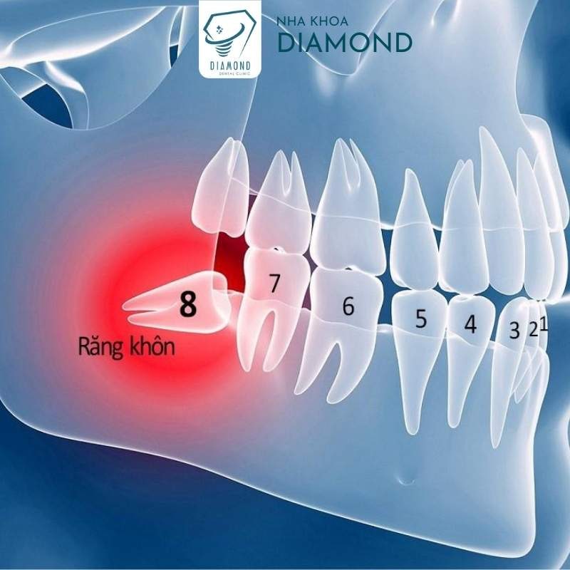 Dịch vụ nhổ răng khôn tại Nha khoa Diamond